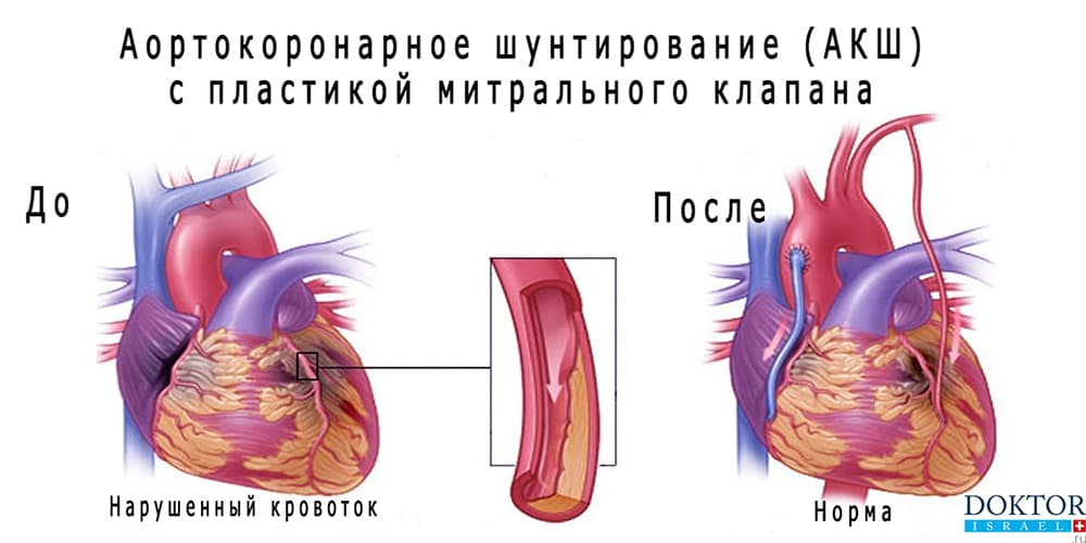 Операция аортокоронарного шунтирования артерий